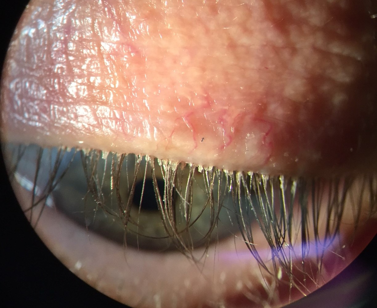 What Is Blepharitis & Meibomitis? 