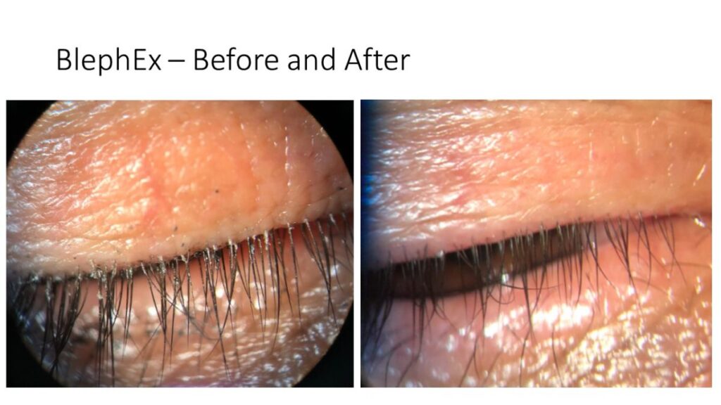 Dry Eye And Blepharitis