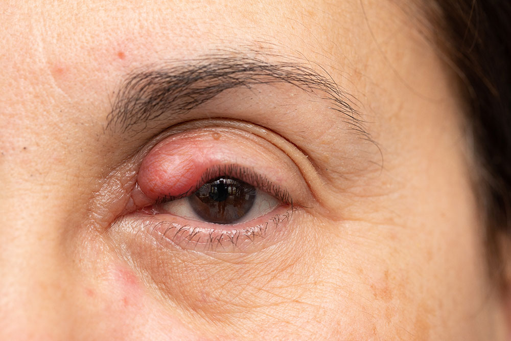 Close-up of a woman’s eye showing noticeable swelling and redness, indicating a possible eye infection or allergic reaction. Relevant for discussions on eye health.