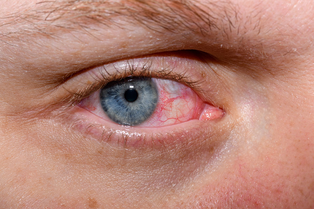 Close-up of a human eye showing a blue iris with visible red veins in the sclera, indicating possible irritation or health issues.
