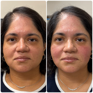 before-and-after-of-optilift-treament