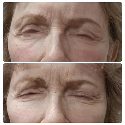 OptiLift-treatment-for-poor-eyelid-closure